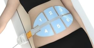 Non-invasive fat reduction treatment procedure on abdomen