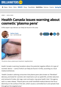 Health Canada warns about cosmetic plasma pens' potential risks