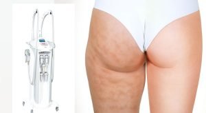 Cellulite treatment machine beside woman showing cellulite on thigh